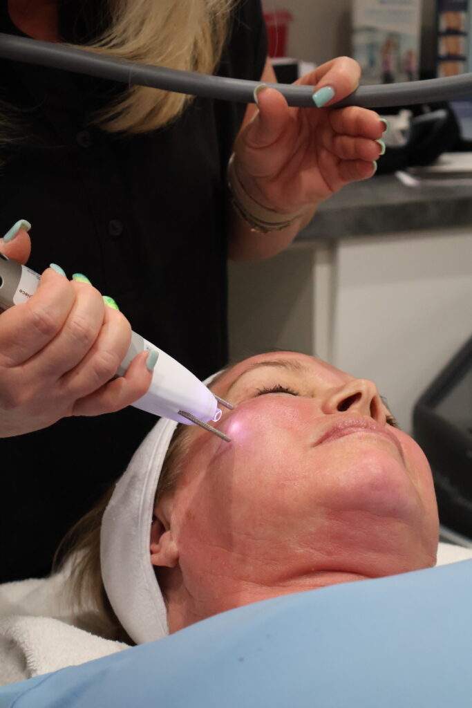 PLADUOpro Procedure
