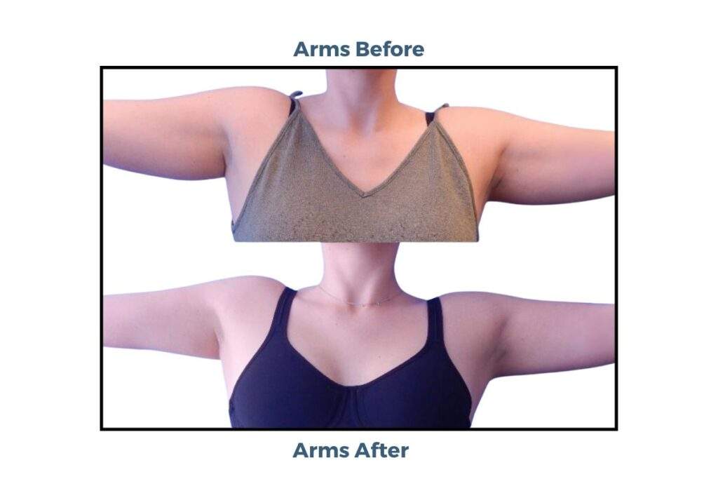 Coolsculpting Elite Offer