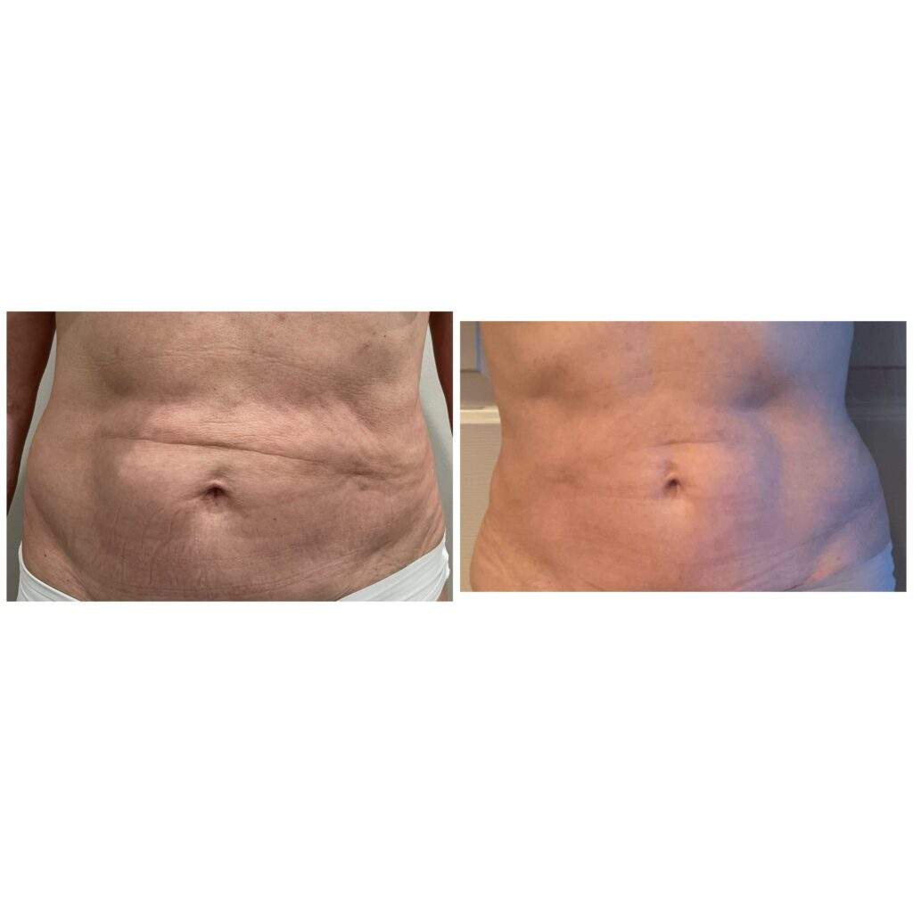 Skin Tightening Scottsdale