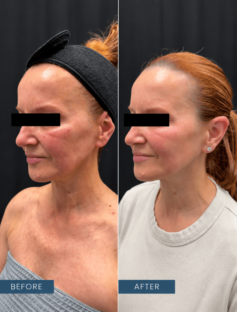 Before-and-after side views following PLADUOpro treatment at Contour You; patient eyes covered