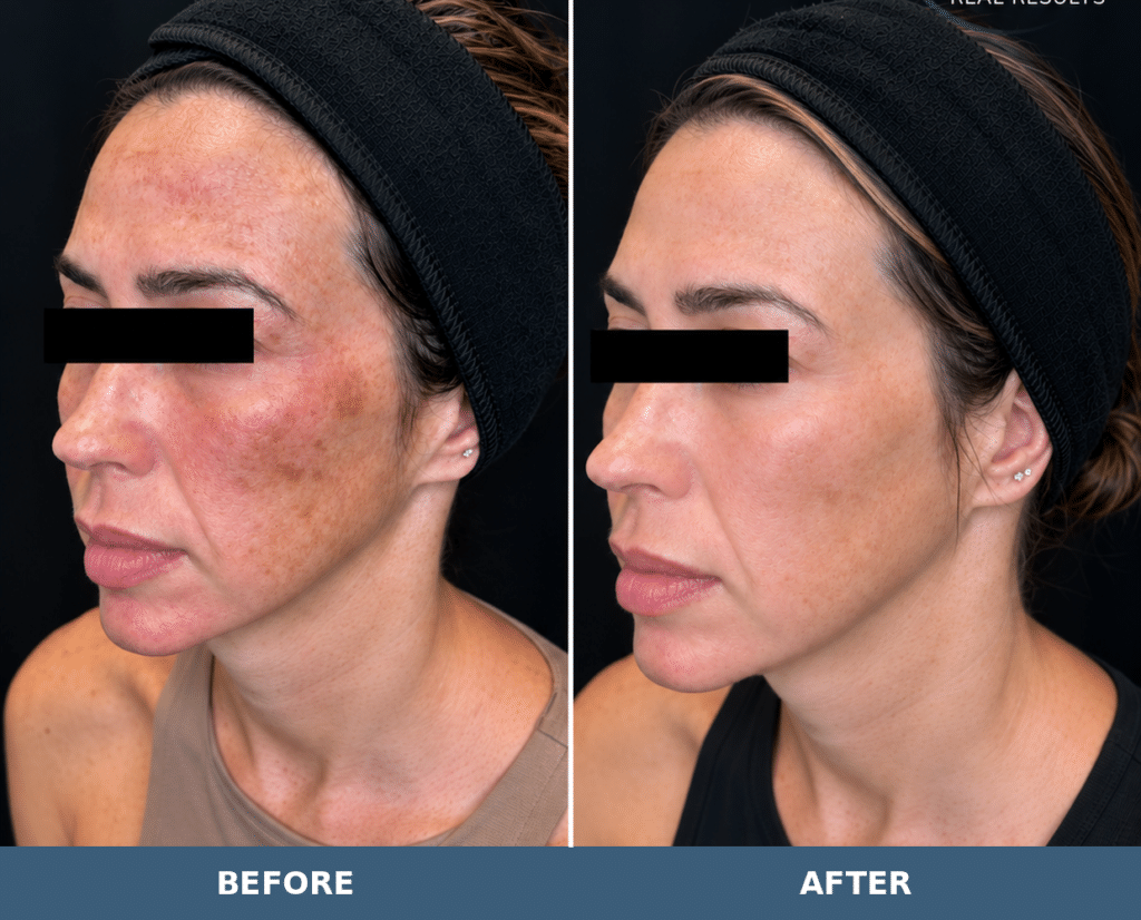 Before-and-after facial views following BBL treatment at Contour You; patient eyes covered