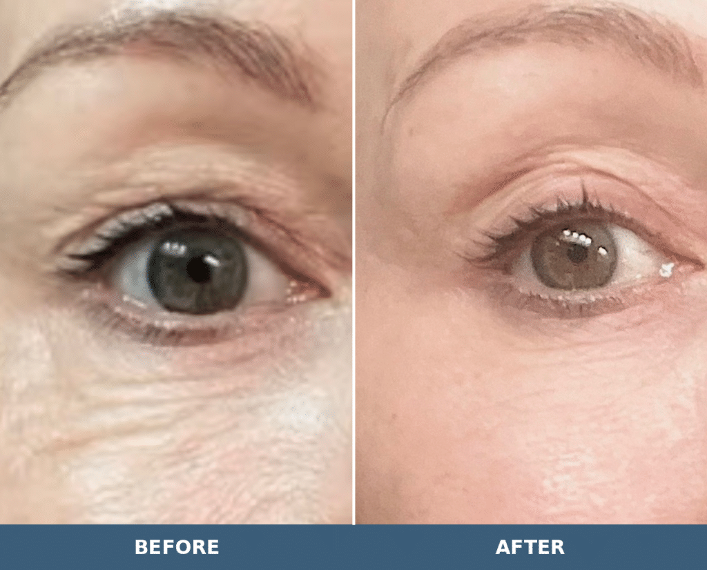 Before-and-after views of the eye area following PLADUOpro treatment at Contour You