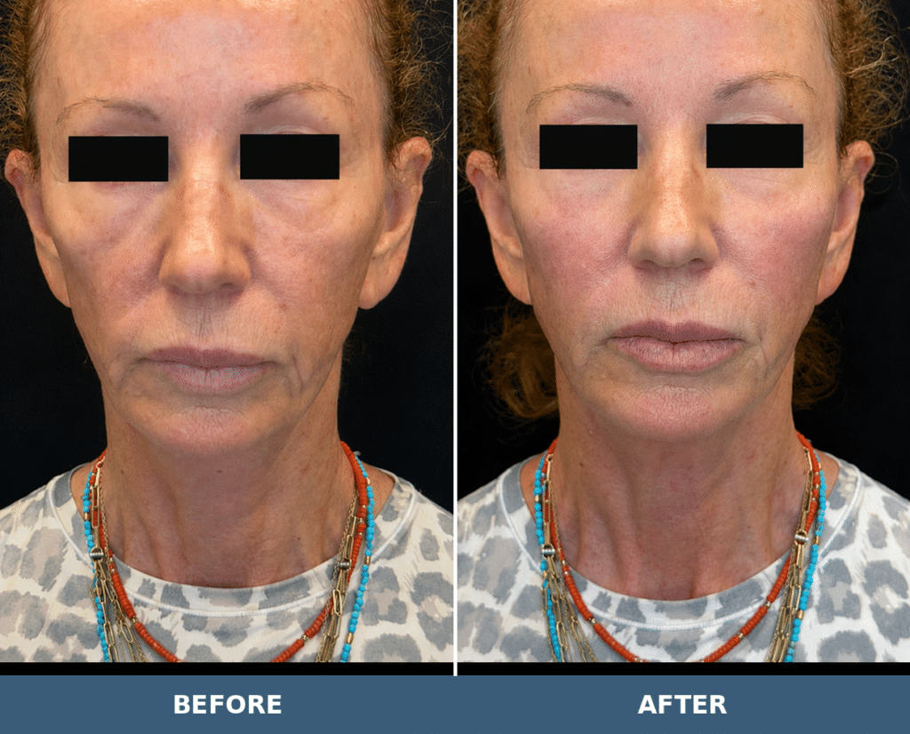 Before-and-after facial balancing views following HA filler and Radiesse treatment at Contour You; patient eyes covered