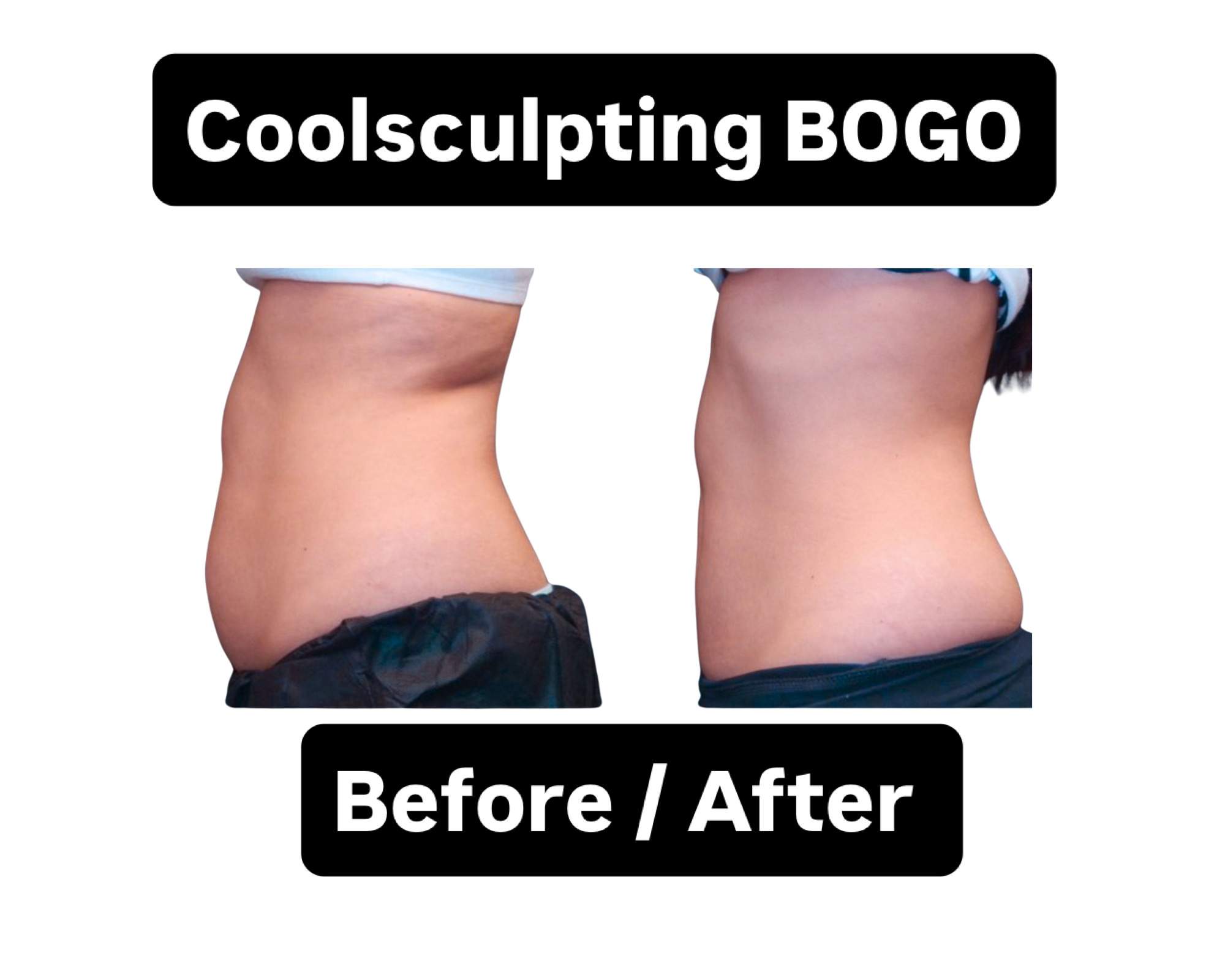 CoolSculpting abdomen before-and-after side views
