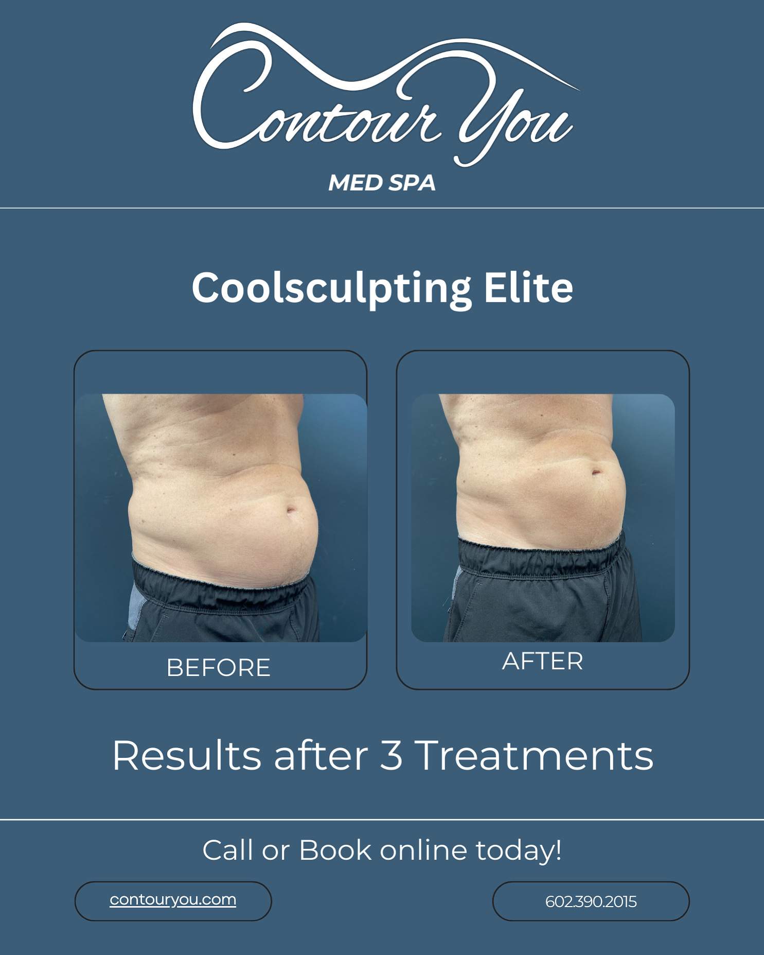 Contour You CoolSculpting Elite abdomen before-and-after photos showing results after three treatments