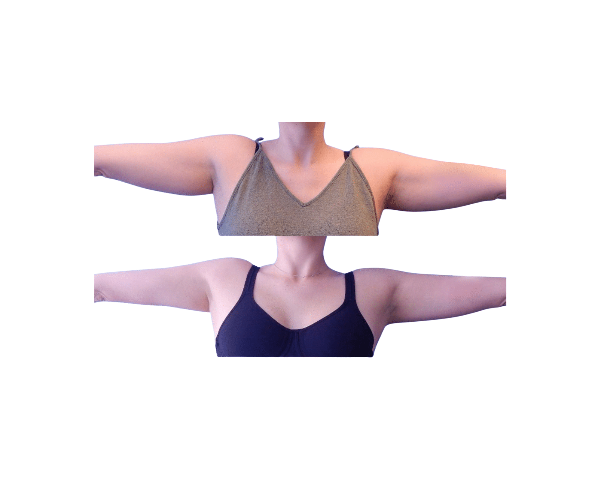 Upper arms before CoolSculpting at Contour You